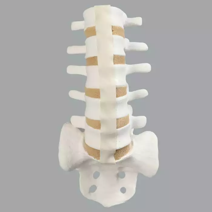Spine, Lumbar, L1-Sacrum, Foam Cortical Shell
