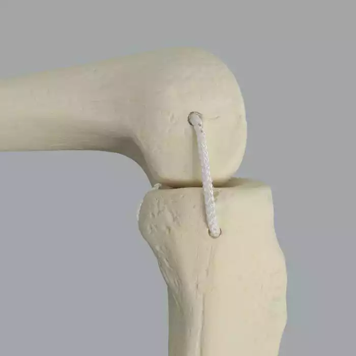 Knee with Three Nylon Non-Stretch Ligaments and Narrow Intercondylar Notch, Full Length